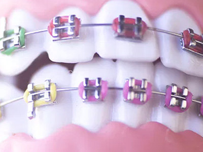 The image shows a close-up of a person s teeth with colorful braces, featuring multiple bands in various colors.