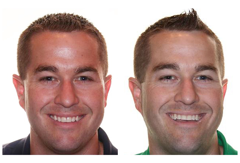 Atlantic Avenue Braces