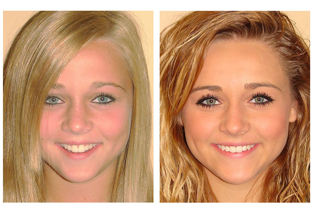 Atlantic Avenue Braces