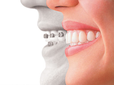 The image is a composite of two photographs, one showing a person s face with a wide smile and the other depicting a dental implant.