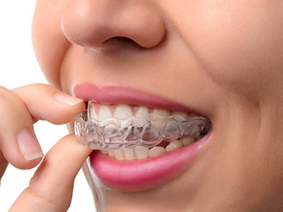 Woman wearing clear aligners, examining her teeth with a finger.